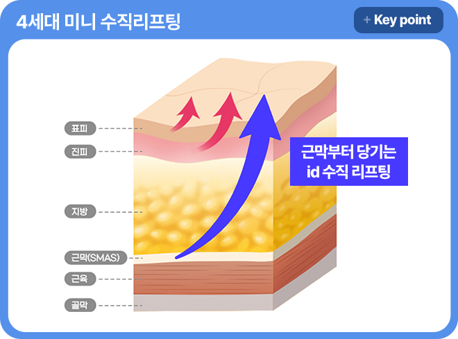 아이디병원 - 4세대 미니 수직리프팅 - 근막부터 당기는 id 수직 리프팅 - 리프팅
