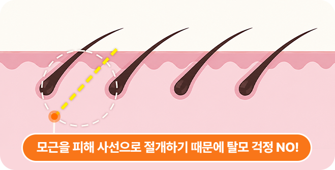 아이디병원 - 미니 수직리프팅 절개 부위 - 모근을 피해 사선으로 절개하기 때문에 탈모 걱정 NO - 리프팅