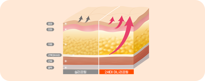 3중 리프팅