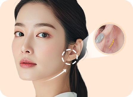 귀 뒤 1cm 최소 절개로 티나지 않는 흉터!