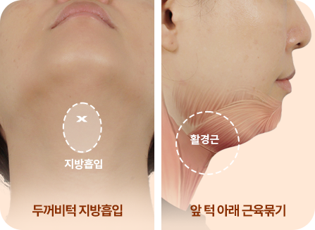 완벽한 V라인의 완성