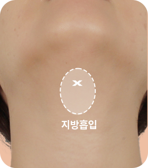 지방흡입 후 턱 아래 근육 묶기