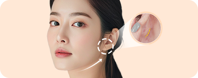 귀 뒤 1cm 최소 절개로 티나지 않는 흉터!