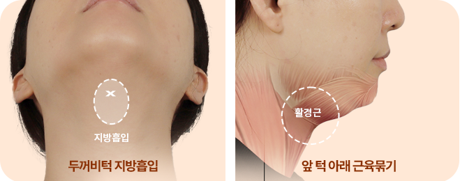 완벽한 V라인의 완성