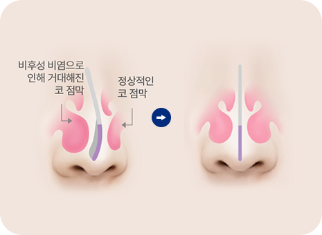 비후성 비염