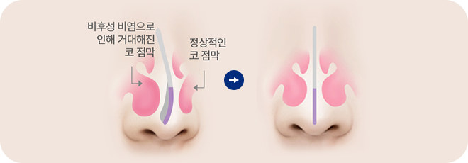 비후성 비염