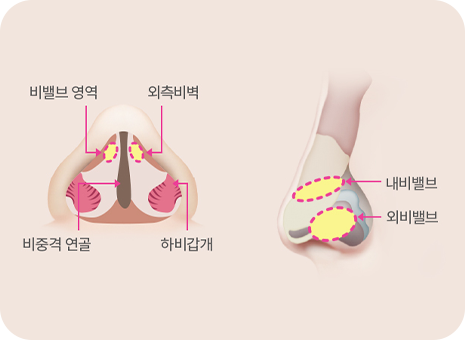 비밸브 협착증