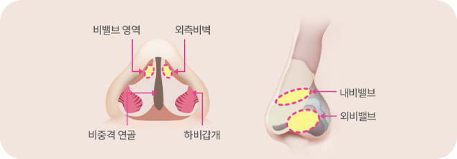 비밸브 협착증