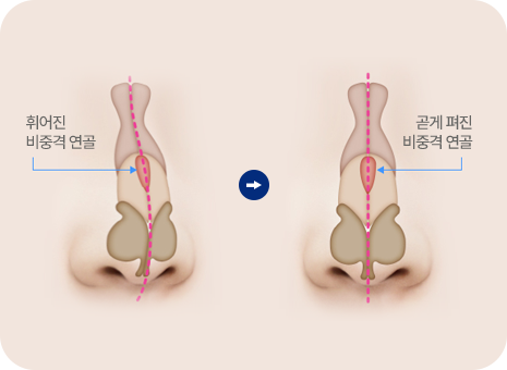 비중격 만곡증