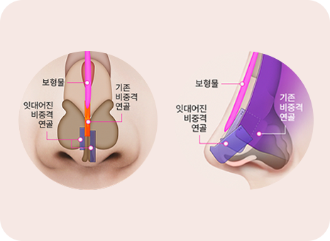 3단직렬 연장술