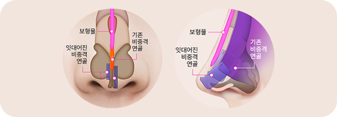 3단직렬 연장술