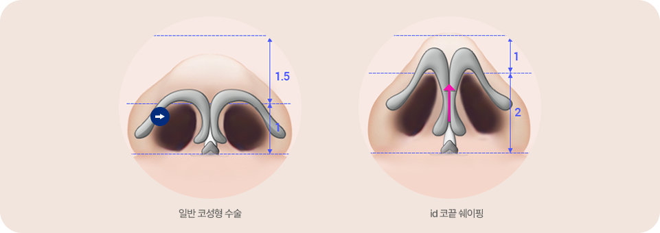 미용 코성형