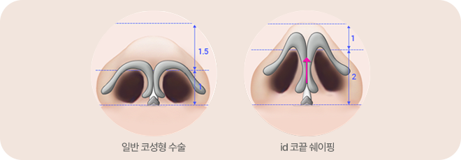 미용 코성형