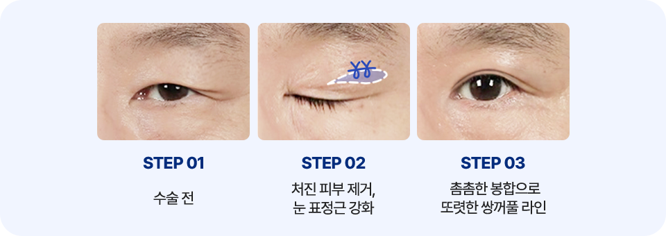 남자 상안검