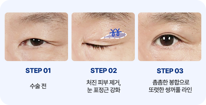남자 상안검