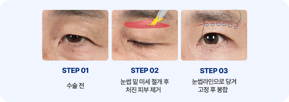 눈썹 거상술