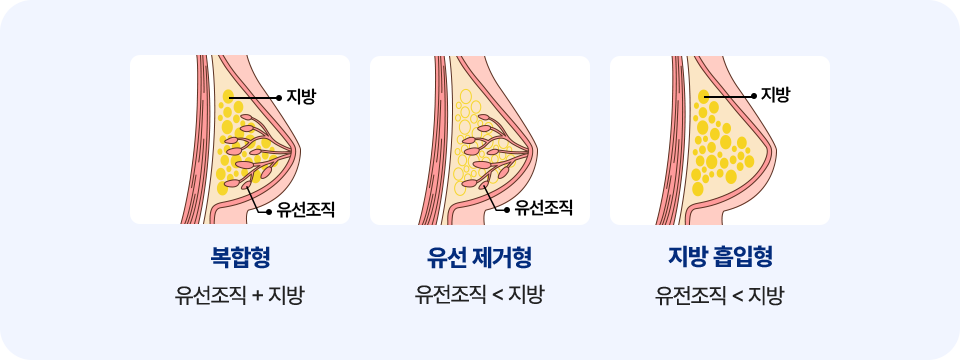 여유증 타입