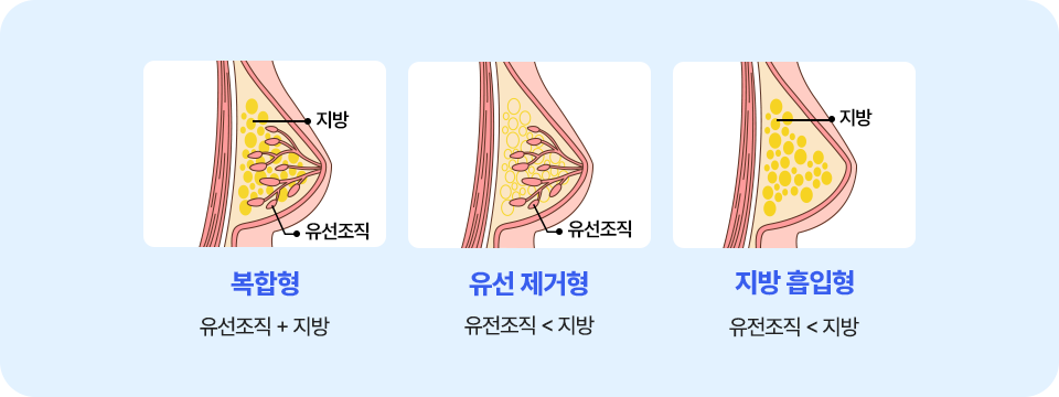 여유증 타입