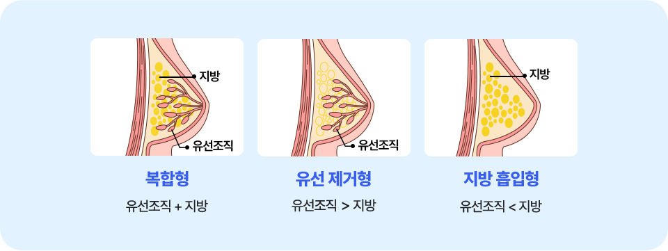 여유증 타입