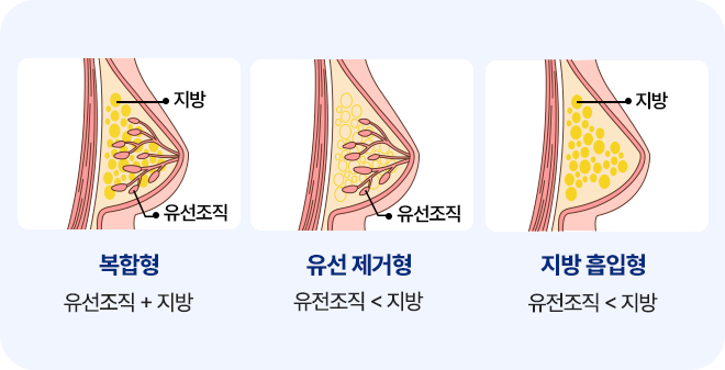 여유증 타입