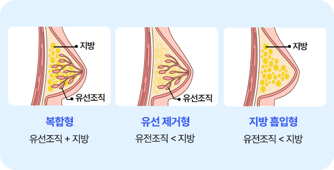 여유증 타입