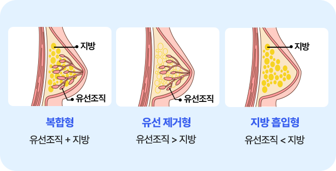 여유증 타입