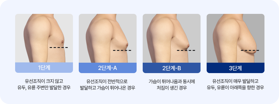 여유증 단계