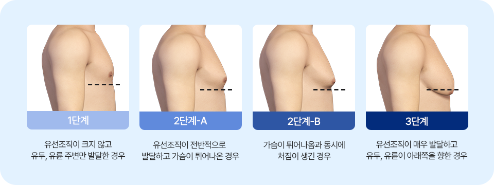 여유증 단계