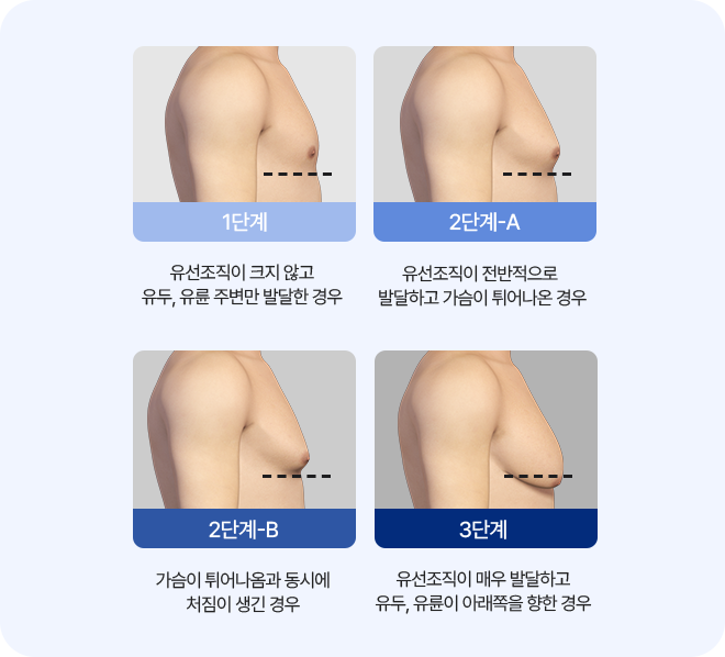 여유증 단계