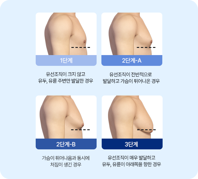 여유증 단계