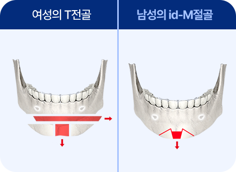 id-M 절골 수술법