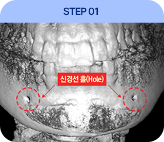 3D-CT촬영