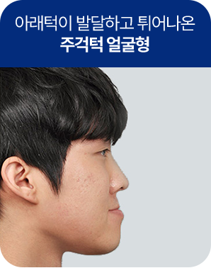 주걱턱 얼굴형형