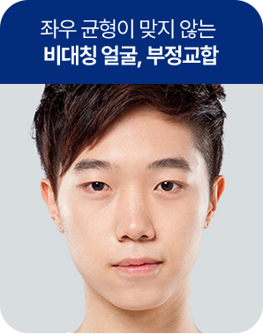 비대칭 얼굴, 부정교합