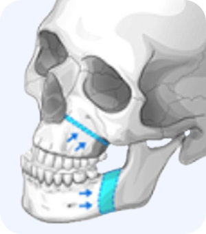 3D 시뮬레이션으로 계획 후 수술