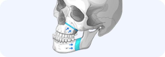 3D 시뮬레이션으로 계획 후 수술