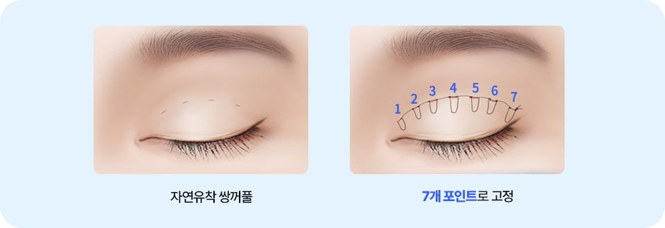 남자 자연유착 매몰