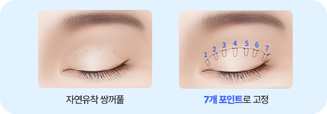 남자 자연유착 매몰