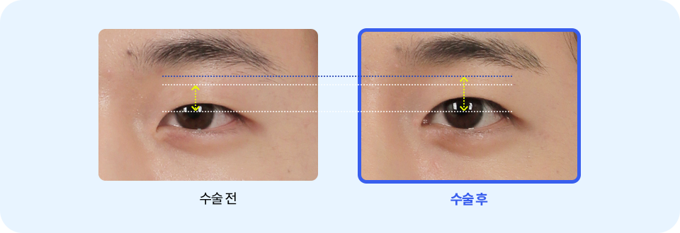 남자무쌍 눈매교정