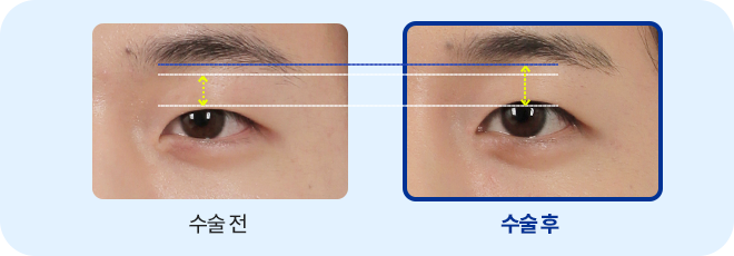 남자무쌍 눈매교정