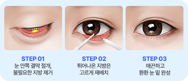 남자 눈밑성형
