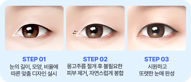 남자 앞트임