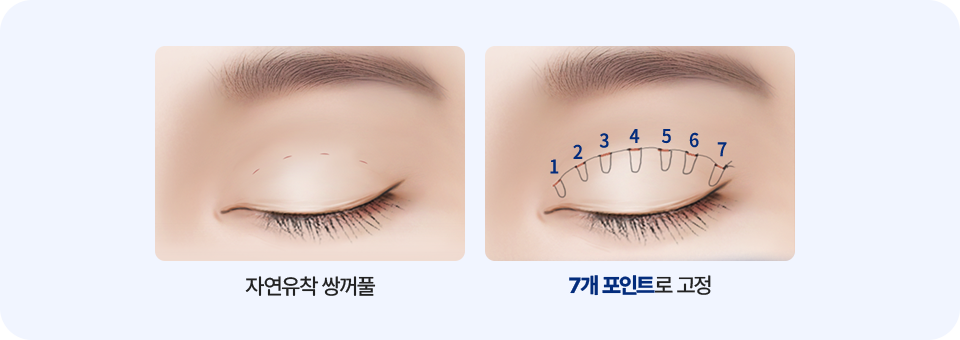 남자 자연유착 매몰