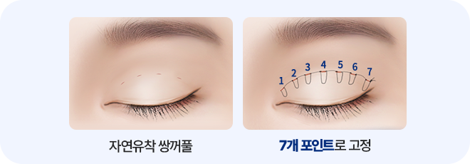 남자 자연유착 매몰