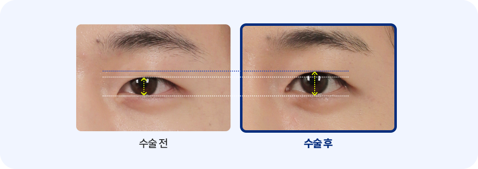 남자무쌍 눈매교정