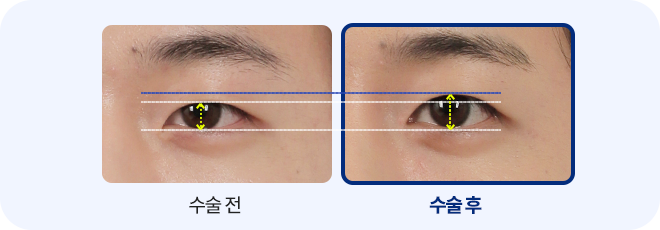 남자무쌍 눈매교정