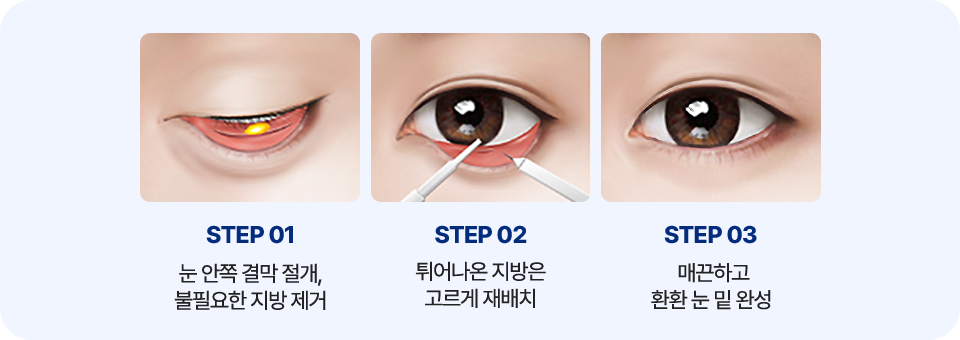 남자 눈밑성형