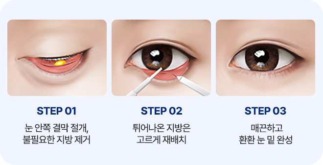 남자 눈밑성형