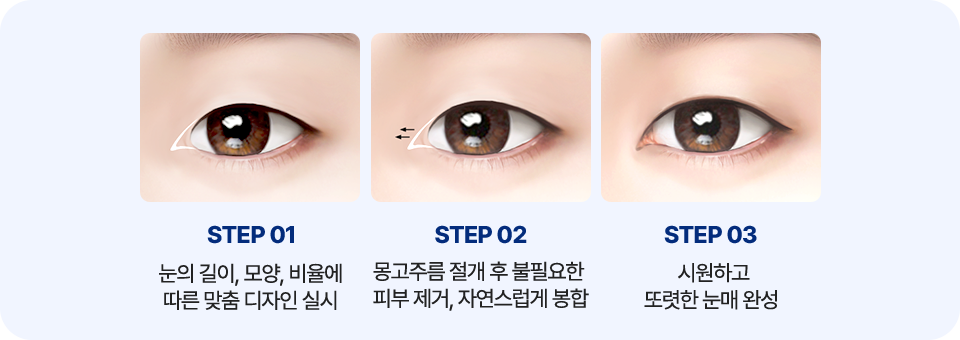 남자 앞트임