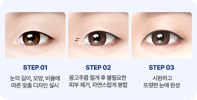 남자 앞트임